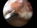 Arthroscopic Subacromial Decompression