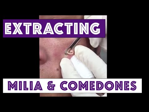 how to do acne extractions at home