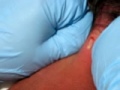 JohnCyst Pt2.avi