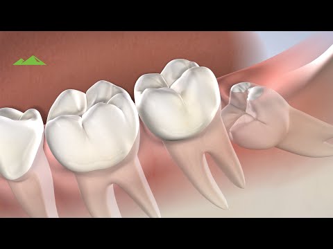 how to relieve wisdom tooth pain after surgery