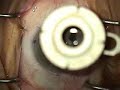 Cataract Surgery implantion of the Alcon Toric SN60T5 IOL