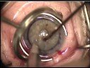 Descemet Stripping Automated Endothelial Keratoplasty 2