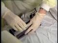 Cord Blood Stem Cell Transfusion Saves 3-Year-Old Child