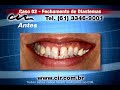 Fechamento de Diastemas CIR Bras�lia (61) 3346-9001