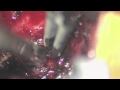 Schwannoma Excision Using Minmally Invasive Robotic Da Vinci System - Part 1