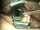 Lasek eye surgery video Lasek eye surgery video