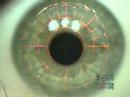 lasek eye surgery video