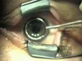 Lasek eye surgery video Lasek eye surgery video