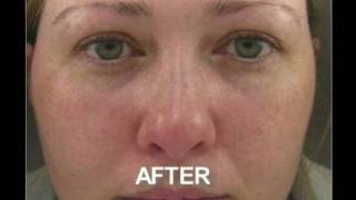 IPL Skin Rejuvenation