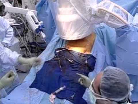 how to repair aortic aneurysm