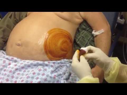 how to perform paracentesis