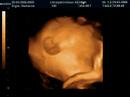 3D Ultrasound of Jacob - 4