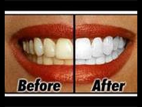 how to whiten teeth while sleeping