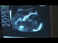 Amazing Ultrasound of Baby Yawning!