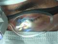 My Ethnic Rhinoplasty ( Nose Job ) Surgery in Beverly Hills