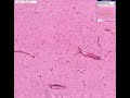 Histopathology Brain--Viral encephalitis Encephalitis