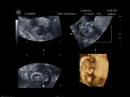 Ultrasound - 15 Weeks