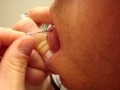 Oozing Mouth Zit!