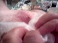 my mom popped a cyst on my back part 2