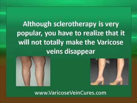 how to relieve varicose veins in pregnancy