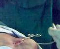 Pacemaker implantation in IGH-1