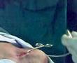 Pacemaker implantation in IGH-1