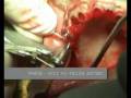 Dental Implants In India with Immediate Function ( English Sub headings)