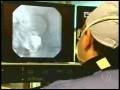 videos de BRAIN ANEURYSM-ANEURISMA CEREBRAL