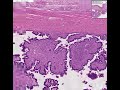 Histopathology Ovary--Borderline ovarian tumor
