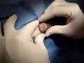 HUGE Feline Sebaceous Cyst Expression