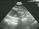 Lithotripsy