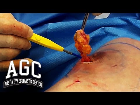 how to cure gyno