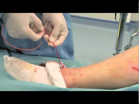 safenectomia - Site web: www.sos-vaisseaux.com Stripping de varices Service de Chirurgie Vasculaire de l'Hôpital de Pontoise.