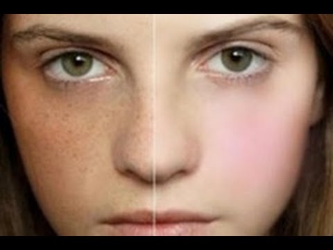 video-linktoworks-how to get rid of freckles