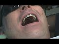 Full Braces Install