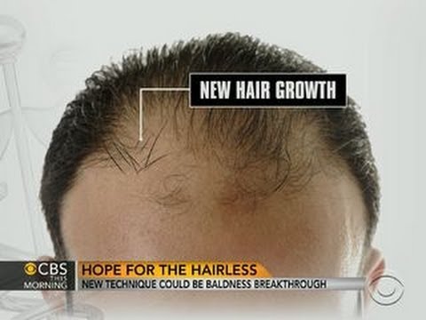 how to cure baldness