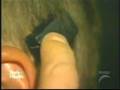 Bone Anchor Hearing Aid Experiences