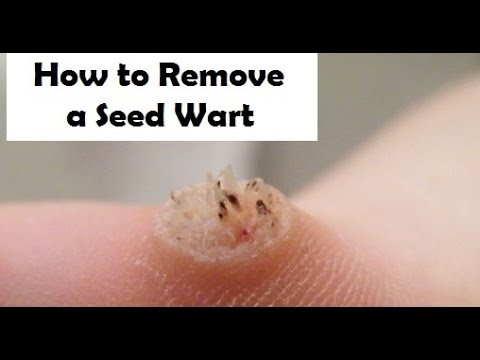 how to treat warts