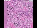 Histopathology Prostate--Adenocarcinoma (Gleason grade 5)