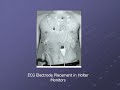 Sleep Apnea Detection using Electrocardiogram
