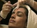 Philadelphia Microdermabrasion Dermatologist in Ardmore Philadelphia Microdermabrasion Dermatologist in Ardmore