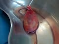 GALL BLADDER STONE april 15, 2009!
