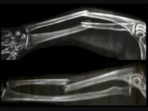 how to know fracture in x-ray