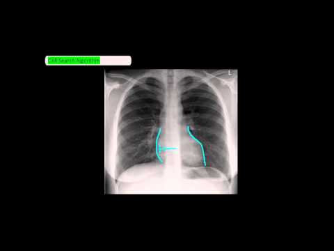 how to read chest x ray