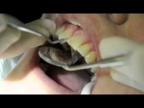 BONDING - Complete teeth bonding procedure. No needles. The case was completed in 1 1/2 hrs. by Dr. Rick O'Braitis Send a photo of your smile to Dr.Rick@drobraitis.com...