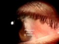 pterygium and fibrin glue