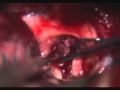 Transbasal Translamina Terminalis Approach for Retrochiasmatic Craniopharyngioma-James K. Liu, MD