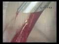 Gran Callejo 2ª parte