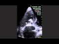 Tricuspid Valve Calcification Tricuspid Valve Calcification