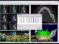 videos de Bioparts - Tutorial 11 DentalSlice: Excluindo implantes